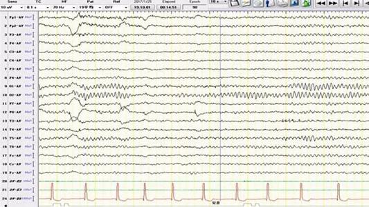 研究人員在睡眠實(shí)驗室的兩個(gè)不同夜晚獲得了17名健康人的腦電圖記錄