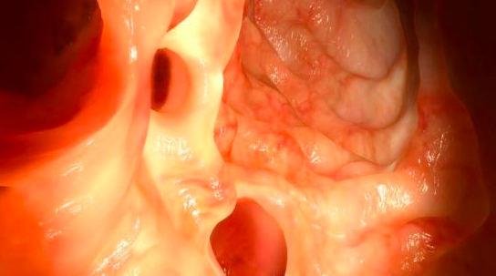 人工智能似乎將進(jìn)入內窺鏡套件