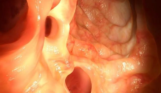 FDA批準了首例結腸鏡檢查AI